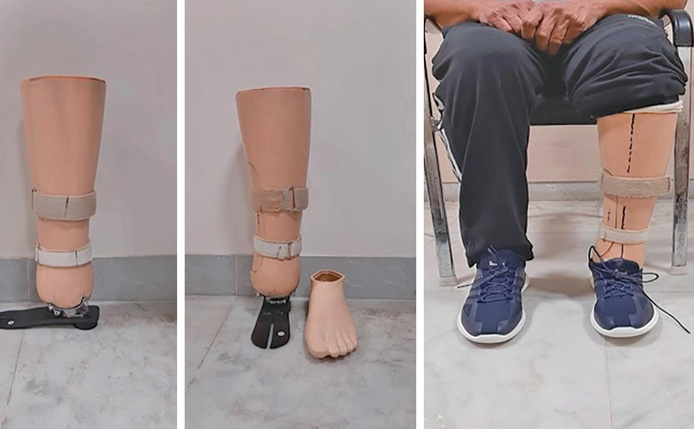Lower Limb Prosthetics