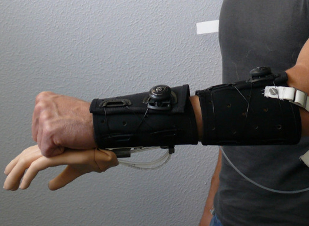 Upper Limb Prosthetics
