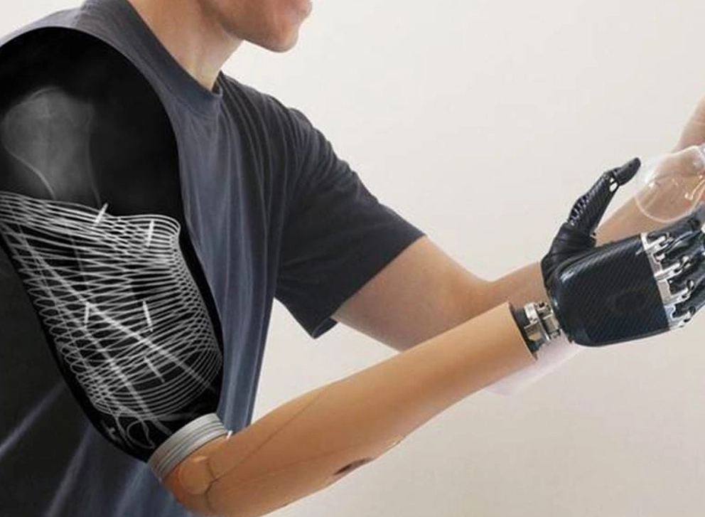 Upper Limb Prosthetics